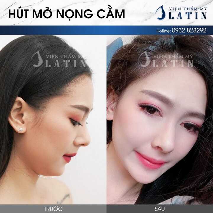 Hút mỡ nọng cằm Hút mỡ nọng cằm