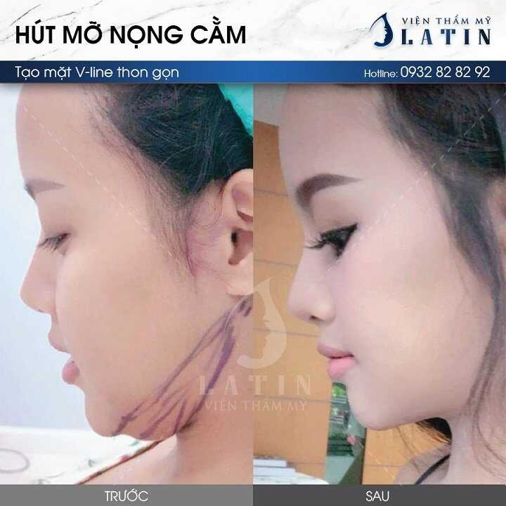 Hút mỡ nọng cằm Hút mỡ nọng cằm