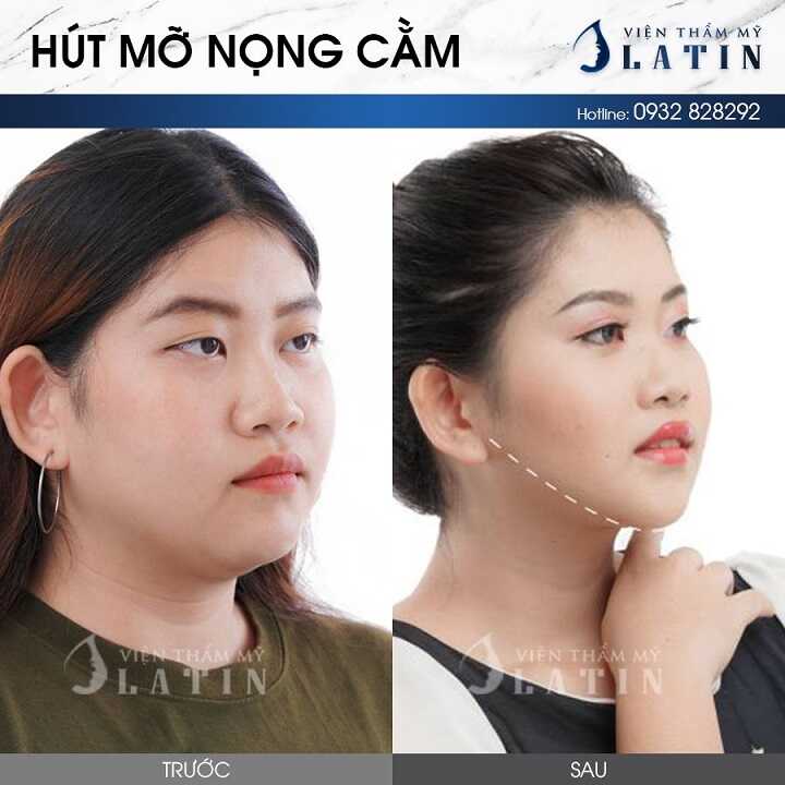 Hút mỡ nọng cằm Hút mỡ nọng cằm