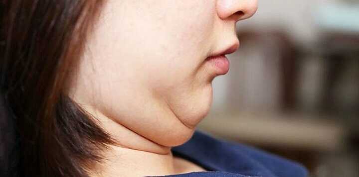 Hút mỡ nọng cằm