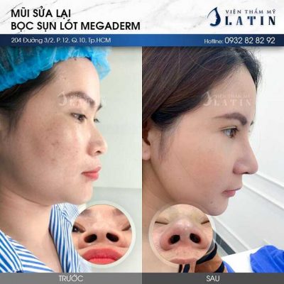 nâng mũi bọc sụn megadermlt