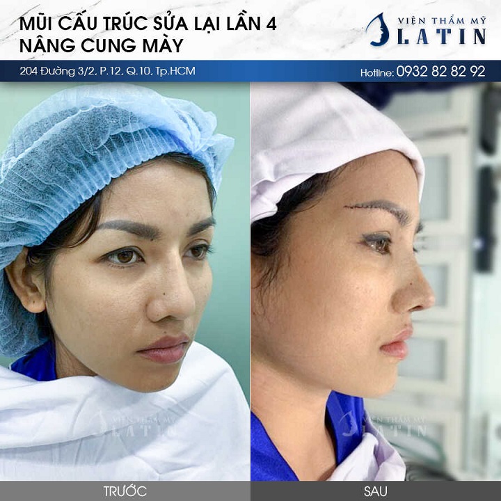 kết quả nâng cung mày tự nhiên tại cơ sở uy tín