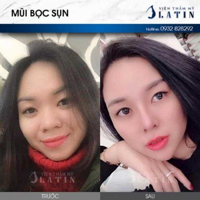 Giá nâng mũi bọc sun