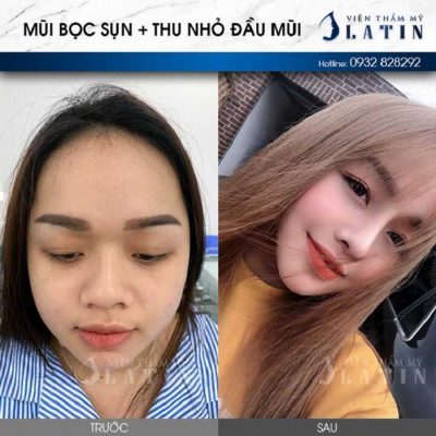 Giá nâng mũi bọc sun