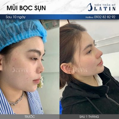 nâng mũi bọc sụn