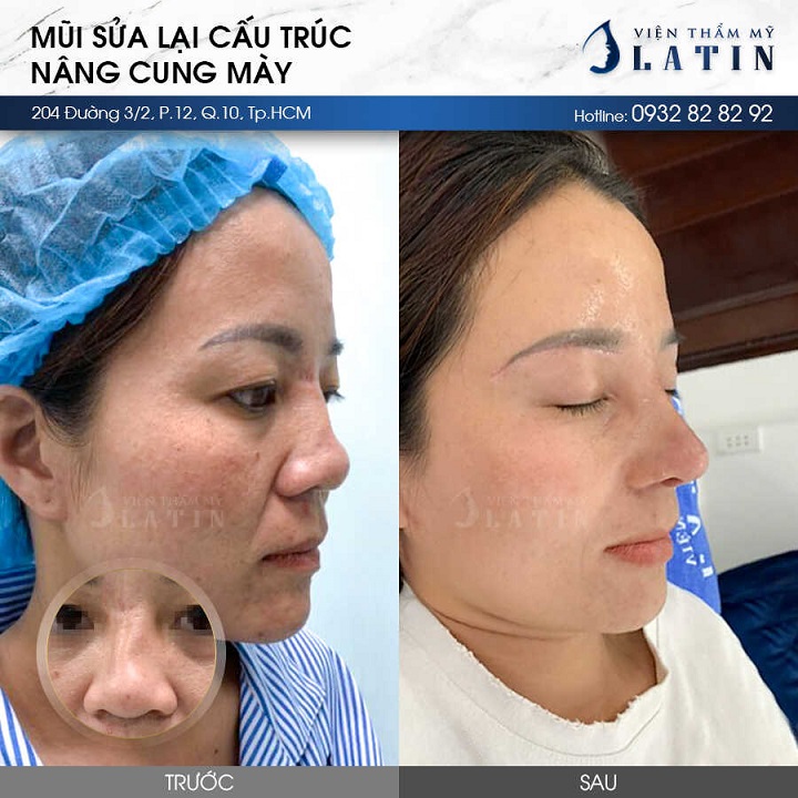 kết quả nâng cung mày tự nhiên tại cơ sở uy tín