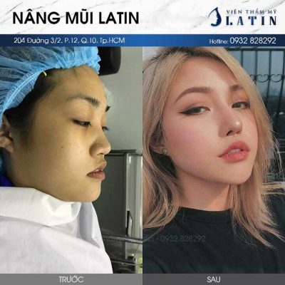 Giá nâng mũi bọc sun