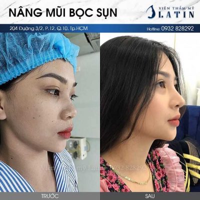 Giá nâng mũi bọc sun