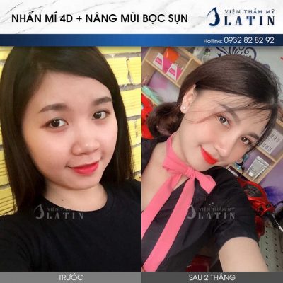 Combo nâng mũi bọc sụn, độn cằm, nhấn mí mắt