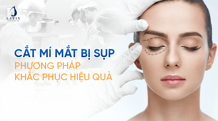 Nguyên nhân mí mắt bị sụp