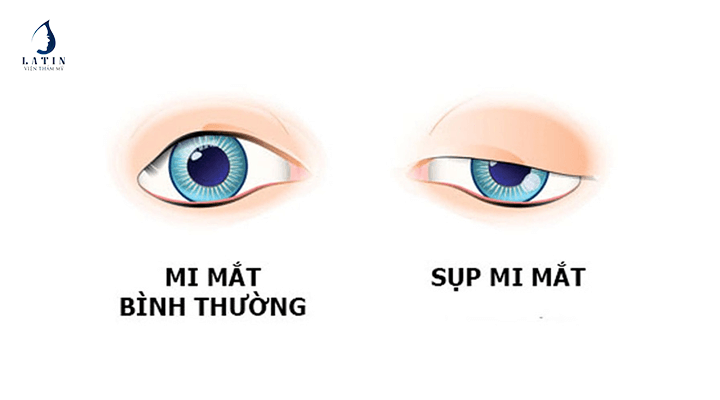 Mí mặt bình thường và Mí mặt bị sụp