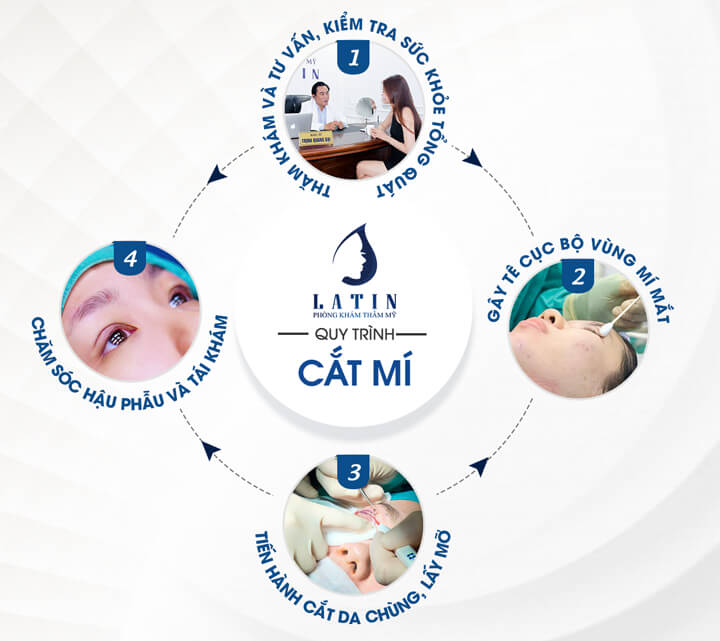 Cắt Da Mí Mắt Trên - Lấy Lại Vẻ Tươi Trẻ Cho Đôi Mắt