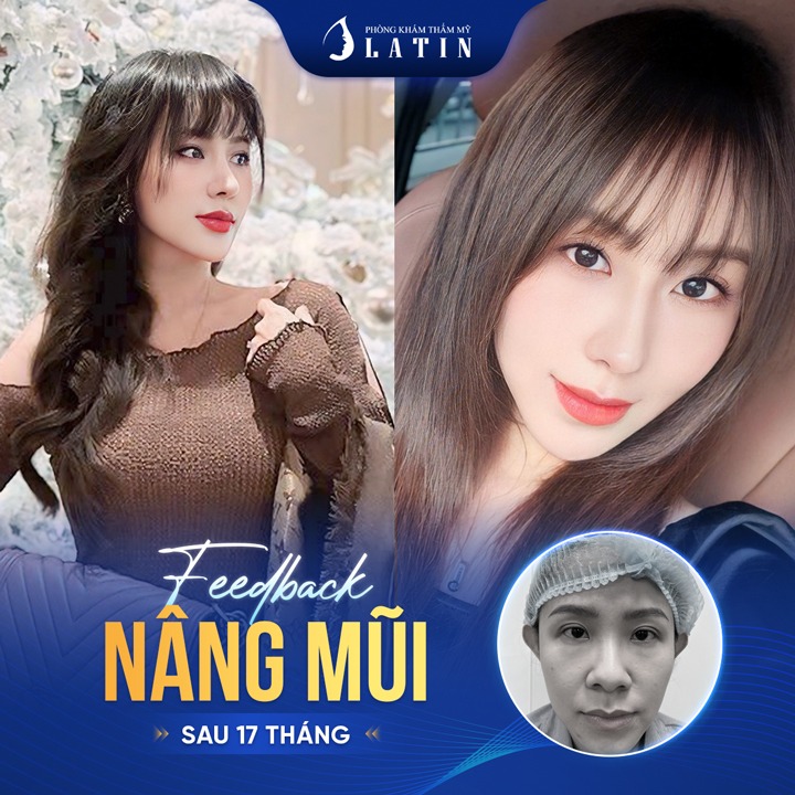 Feedback Nâng Mũi Sau 17 Tháng