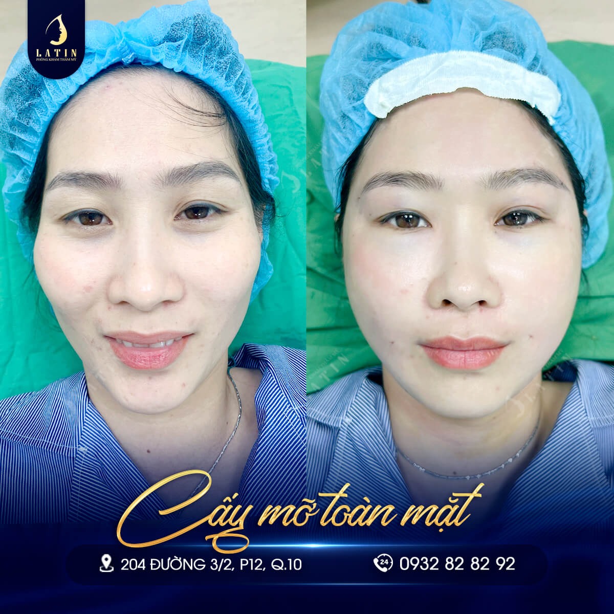 Tiêm rãnh cười