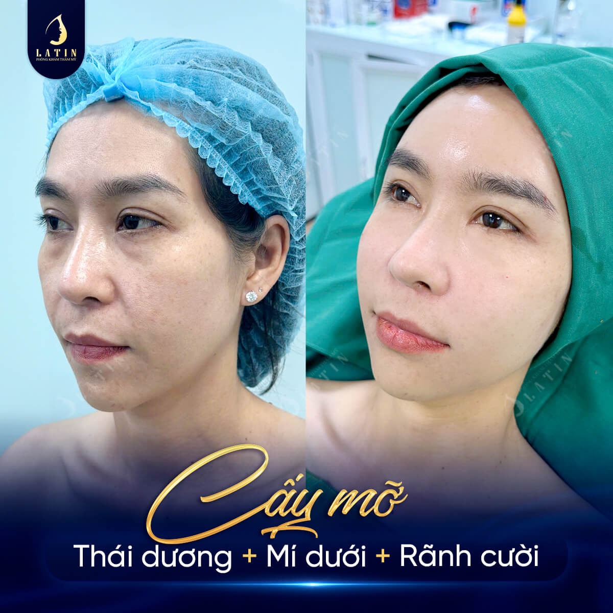 Tiêm rãnh cười