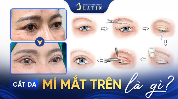 Cắt Da Mí Mắt Trên - Lấy Lại Vẻ Tươi Trẻ Cho Đôi Mắt