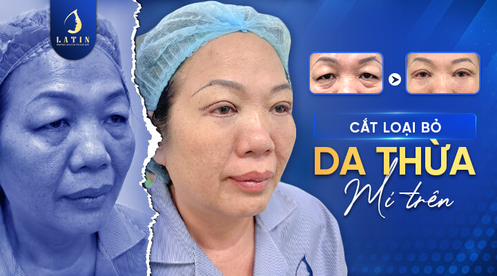 Cắt Da Mí Mắt Trên - Lấy Lại Vẻ Tươi Trẻ Cho Đôi Mắt