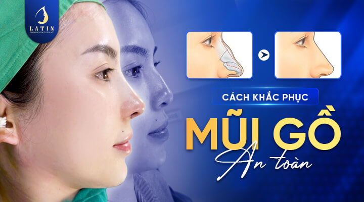 Cách khắc phục mũi gồ an toàn