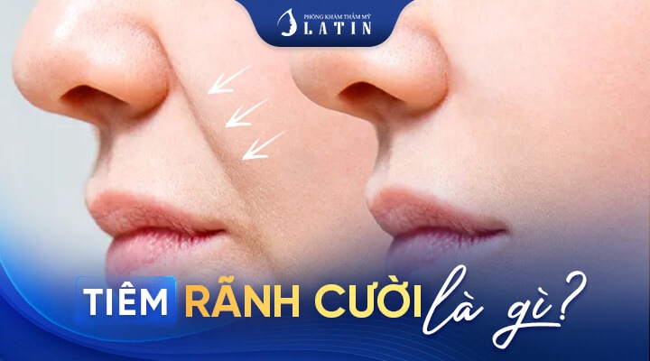Tiêm rãnh cười