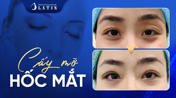Cấy mỡ hốc mắt
