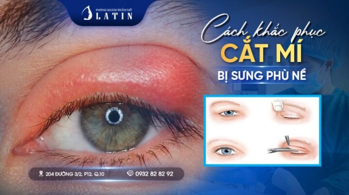 Cách khắc phục cắt mí mắt bị sưng phù nề