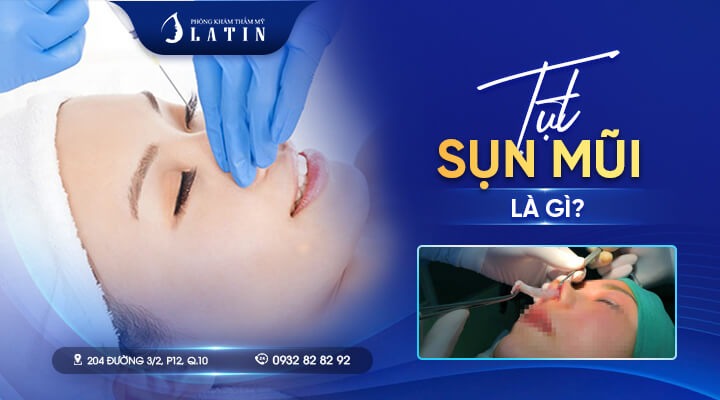 Tụt sụn mũi là gì