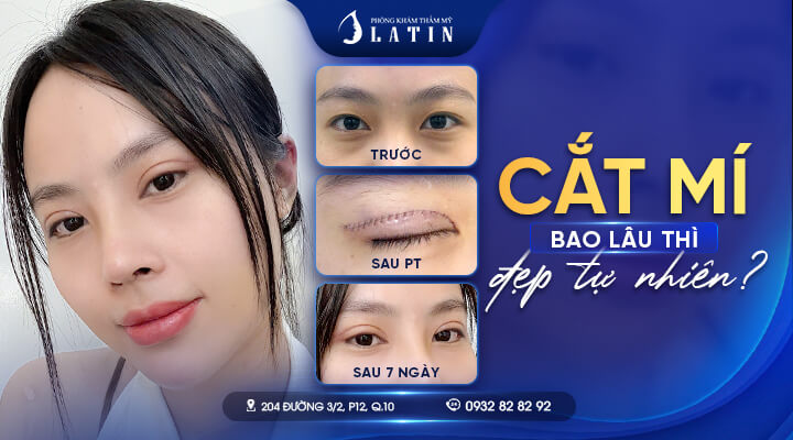 Cắt-mí-mắt-bao-lâu-thì-đẹp-tự-nhiên