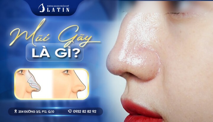 Sửa mũi gãy
