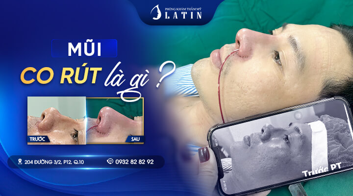 Mũi Co Rút Là Gì