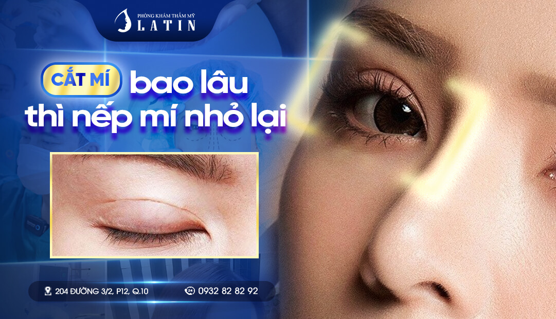 Cắt mí bao lâu thì nếp mí nhỏ lại - Bí quyết để mí đẹp nhanh hơn