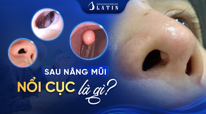 Nổi-cục-sau-nâng-mũi-là-gì