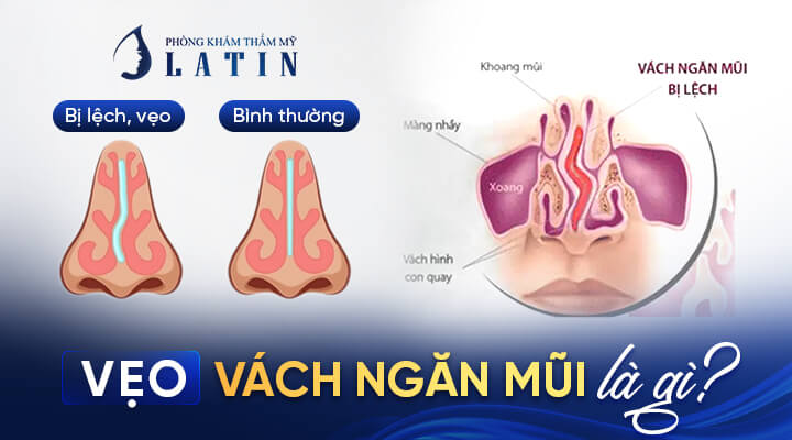 Vẹo vách ngăn mũi là gì