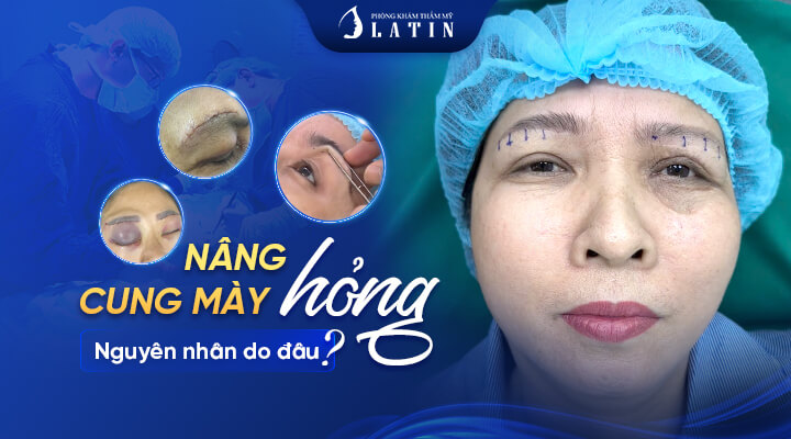 nâng-cung-mày-hỏng-nguyên-nhân-do-đâu