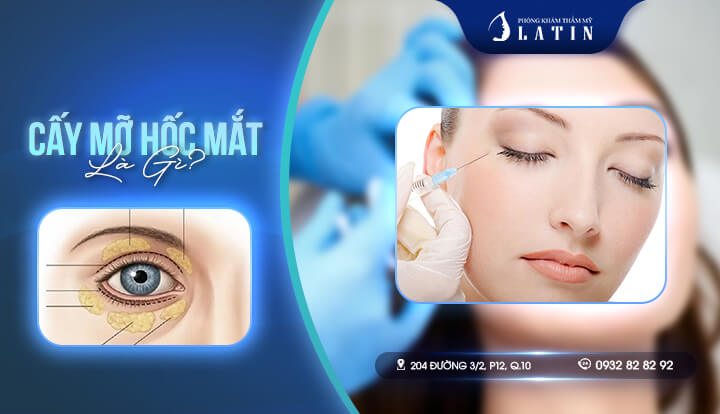 Cấy mỡ hốc mắt là gì