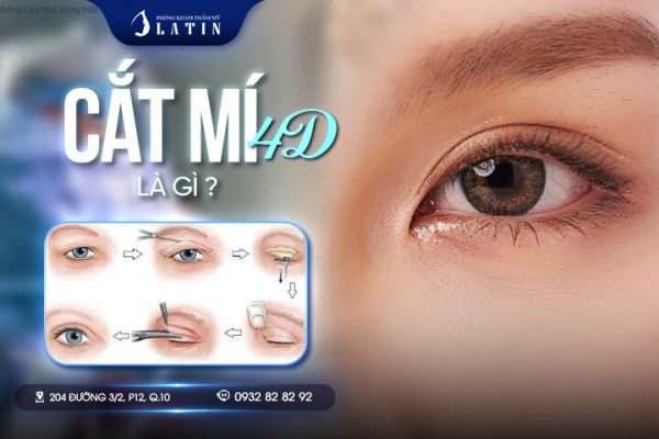 Cắt mí 4D là gì