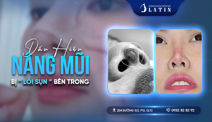 Dấu hiệu nâng mũi bị lòi sụn bên trong