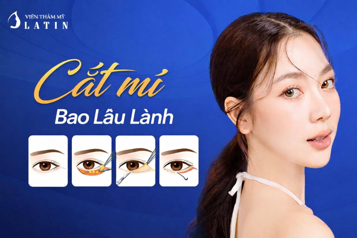 Cắt mí bao lâu lành