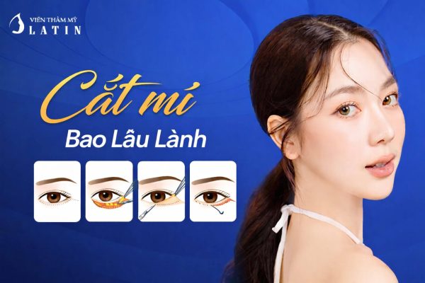 Cắt mí bao lâu lành