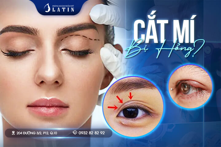 Cắt mí mắt bị hỏng