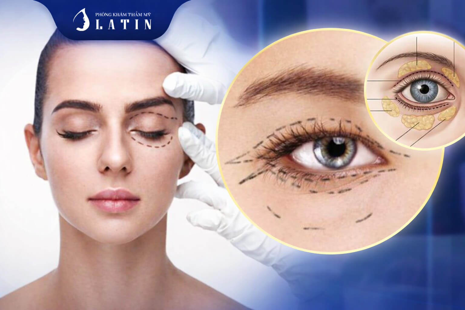 Hướng xử lý biến chứng sau cắt mí an toàn