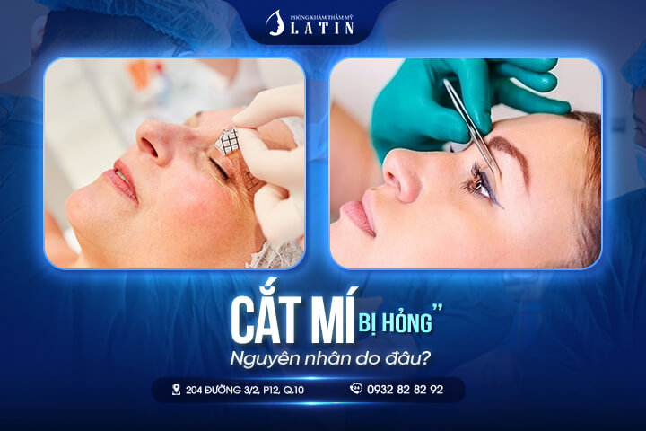 Nguyên nhân khiến cắt mí mắt bị hỏng