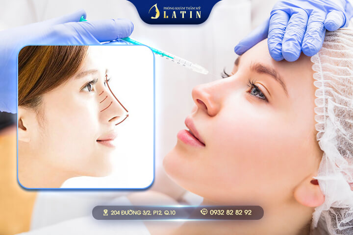 Nâng Mũi Cấu Trúc Giữ Được Bao Lâu