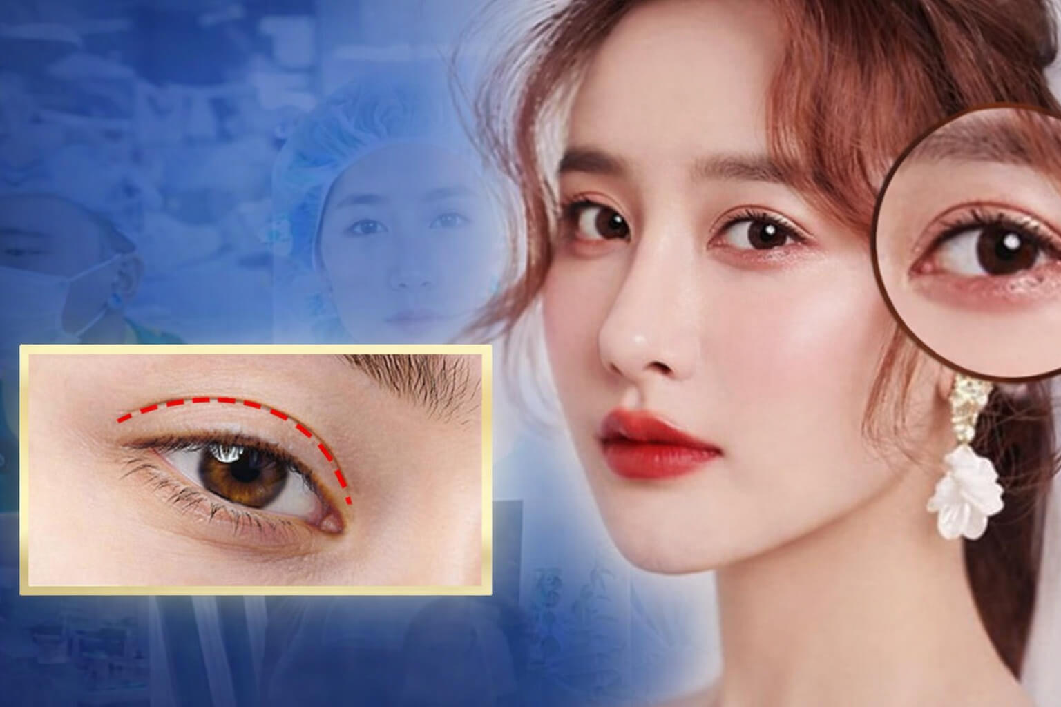 Sửa mí bị hỏng