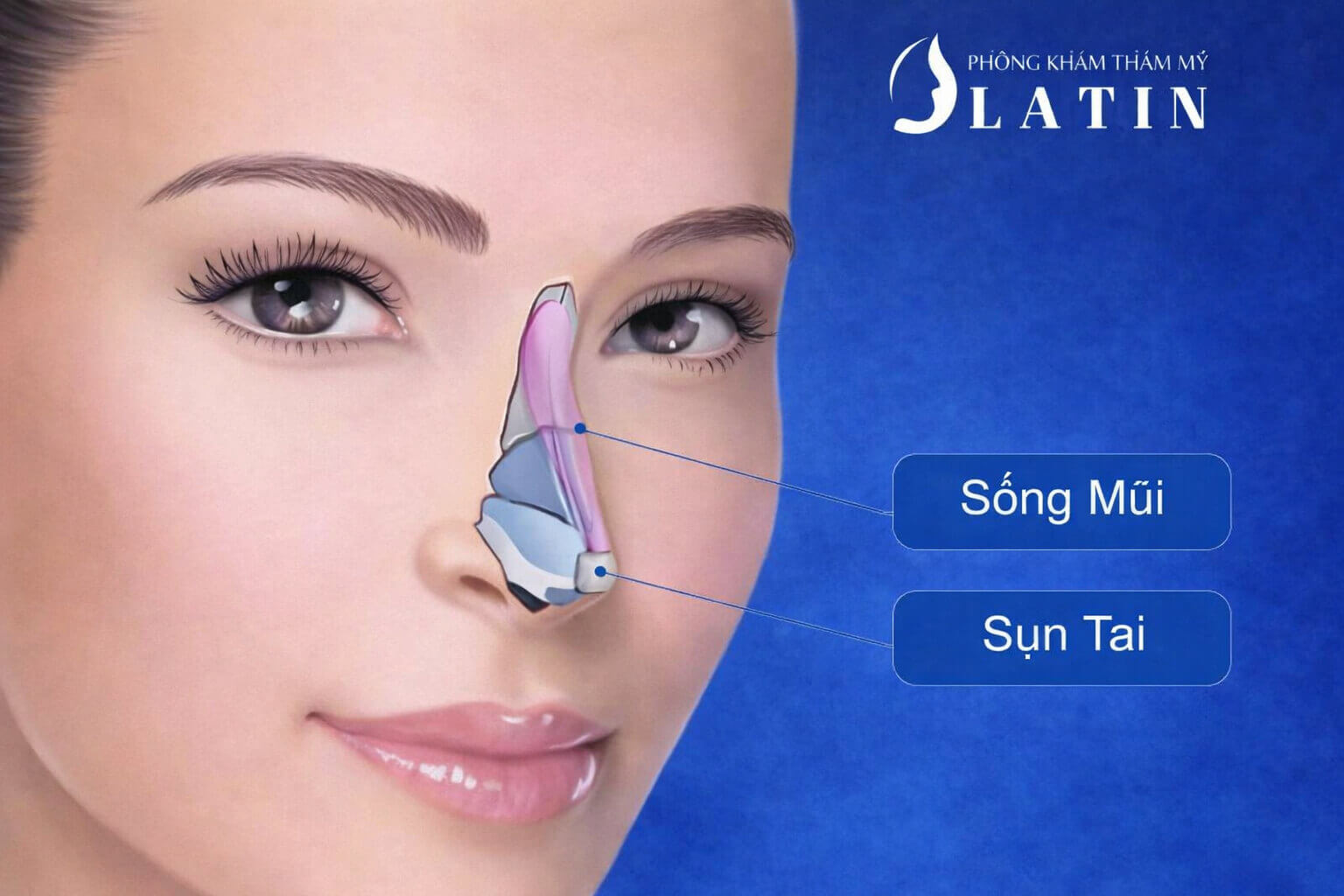 Bọc đầu mũi bằng sụn tai trong nâng mũi cấu trúc