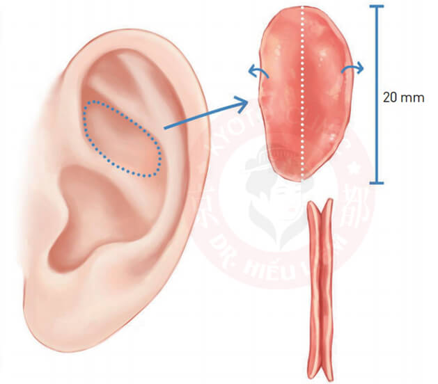 So sánh sụn tai và sụn sườn trong nâng mũi cấu trúc