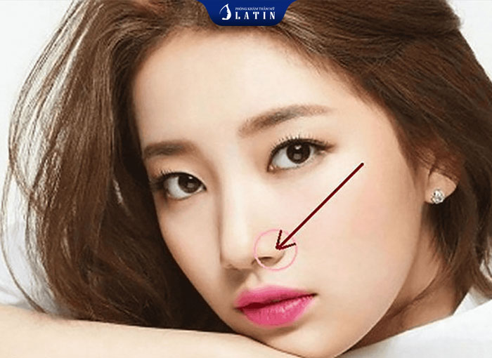 địa chỉ thu cánh mũi uy tín bác sĩ phẫu thuật