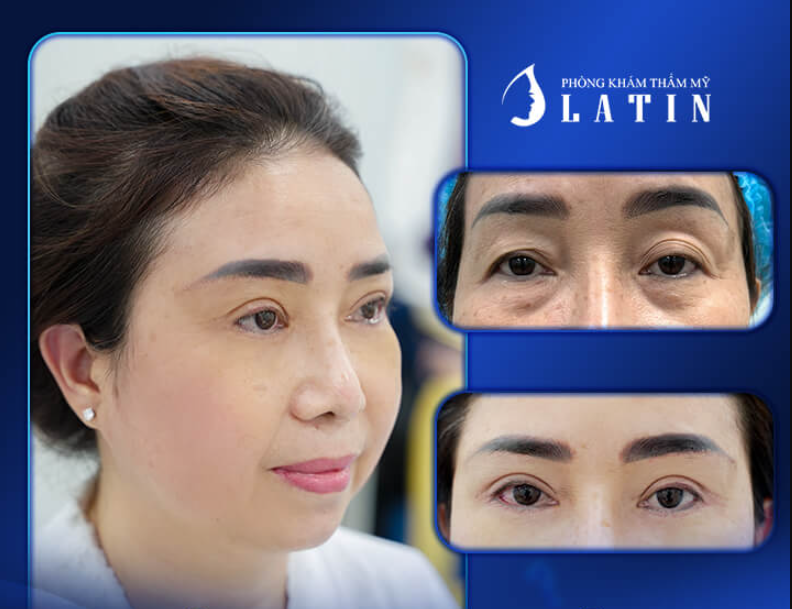 Nâng cung mày hay cắt mí